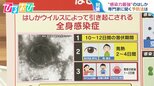 「発症前でも人に感染させる力がある」 感染相次ぐ『はしか』症状と注意点を専門家に聞く【ひるおび】|TBS NEWS DIG