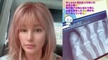 【 梅宮アンナ 】 左足小指を再び骨折 乳がん闘病中に悲痛な報告…「骨がもろくなっている」 治療の副作用への不安も吐露|TBS NEWS DIG