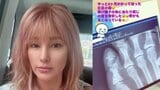 【 梅宮アンナ 】　左足小指を再び骨折　乳がん闘病中に悲痛な報告…「骨がもろくなっている」　治療の副作用への不安も吐露|TBS NEWS DIG