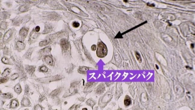 新型コロナワクチン接種後に“がん”再発?患部からワクチンの作り出すタンパク質が…なぜか予測より増えた“がんの死者数”|TBS NEWS DIG