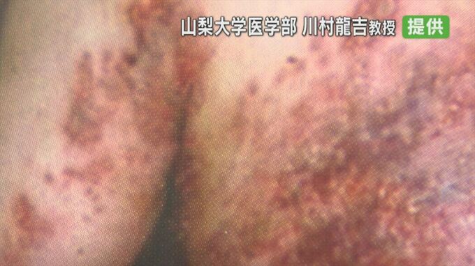 「痛みが強くて2日眠れなかった」3人に1人が発症“帯状ほう疹”　さらに怖いのは後遺症　65歳以上は４月からワクチン定期接種の対象に　|　山梨のニュース | ＵＴＹテレビ山梨