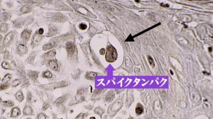 新型コロナワクチン接種後に“がん”再発？患部からワクチンの作り出すタンパク質が…なぜか予測より増えた“がんの死者数”　|　名古屋・愛知・岐阜・三重のニュース【CBC news】 | CBC web