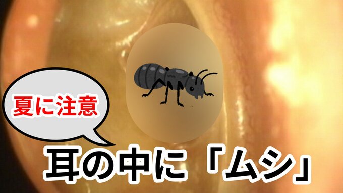 そんなの”アリ!?  ”激痛と騒音が襲う  耳の中に「ムシ」!!   昆虫が活発な夏の時期、就寝中に侵入するケース  「動きが素早いあのムシ」や「脚がたくさんあるムシ」も【画像注意】|TBS NEWS DIG
