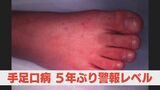 手足口病が警報レベル超え　乳幼児への感染注意喚起　|　長崎のニュース | 天気 | NBC長崎放送