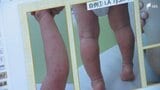「水ぼうそうと間違えられることも多い」手足口病の患者が急増...警報レベル続く 家庭での感染対策は?　|　静岡のニュース | SBSNEWS | 静岡放送