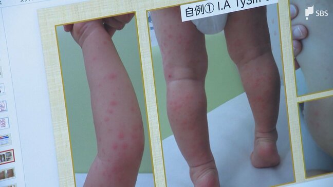 「水ぼうそうと間違えられることも多い」手足口病の患者が急増...警報レベル続く 家庭での感染対策は?|TBS NEWS DIG
