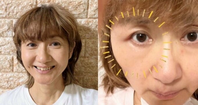【がん闘病】古村比呂さん　帯状疱疹の影響か　右目横の筋肉「プクッと腫れている」　朝には38.1度の発熱も「今は安静第一」|TBS NEWS DIG