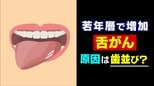 20年で倍増…増える若年層の「舌がん」 現代人特有の “狭い歯並び” が引き金に? 口内炎との決定的な違いとは【2025年度 話題の記事】|TBS NEWS DIG