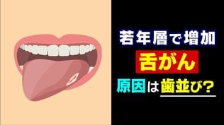 20年で倍増…増える若年層の「舌がん」 現代人特有の “狭い歯並び” が引き金に？ 口内炎との決定的な違いとは【2025年度 話題の記事】　|　富山のニュース｜天気・防災｜チューリップテレビ