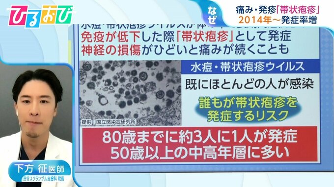 「剣山で刺すような痛み」子育て世代で増加する『帯状疱疹』 気を付けるべき症状を医師に聞く【ひるおび】|TBS NEWS DIG