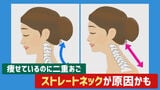 痩せているのに “ 二重あご ”…ストレートネックが原因かも 放置すると「椎間板ヘルニア」のリスクも 若者に多い現代病の対策は | 富山のニュース|天気・防災|チューリップテレビ
