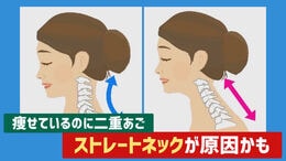 痩せているのに “ 二重あご ”…ストレートネックが原因かも 放置すると「椎間板ヘルニア」のリスクも 若者に多い現代病の対策は|TBS NEWS DIG
