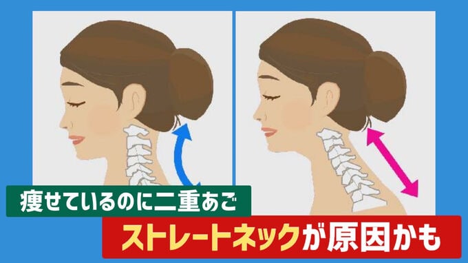 痩せているのに “ 二重あご ”…ストレートネックが原因かも 放置すると「椎間板ヘルニア」のリスクも 若者に多い現代病の対策は　|　富山のニュース｜天気・防災｜チューリップテレビ