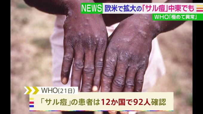 “サル痘”中東でも初確認　WHO「極めて異常だ」