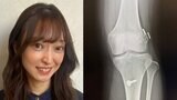 【 広山詞葉 】 1年前の主演舞台で「本番2日目に左膝の前十字靭帯を断裂」 千秋楽完走後に手術していたことを公表 |TBS NEWS DIG