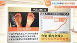 「手足口病」「RSウイルス」なども増加傾向…コロナだけじゃない“こどもの発熱” 親が注意すべきポイントは?医師が解説|TBS NEWS DIG