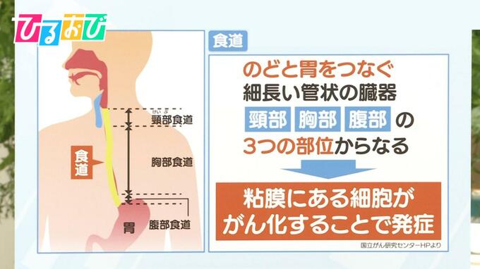 早期発見が“難しい”「食道がん」自覚症状や発見の機会は？【ひるおび】|TBS NEWS DIG