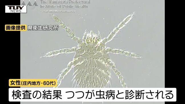 庄内地方に住む60代女性がつつが虫病に感染　県内では今年初（山形）|TBS NEWS DIG