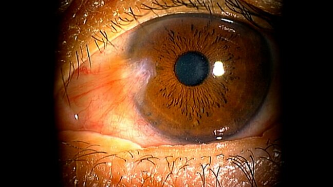 「眠れないほど痛い」目の日焼けに注意！　紫外線で角膜に傷　白目が黒目に入り込む症状も　対策はサングラス　屋内では透明の調光レンズが人気|TBS NEWS DIG