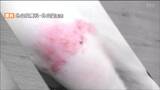 帯状ほう疹ワクチン4月から「定期接種」65歳の市民対象 生ワクチンの自己負担5000円 仙台 | 宮城のニュース│tbc NEWS│tbc東北放送