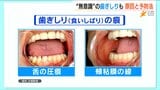 睡眠時も“無意識”も…「歯ぎしり」気になりますか? 実は頭痛、睡眠障害など全身への影響も | 新潟のニュース・天気|BSN NEWS|BSN新潟放送