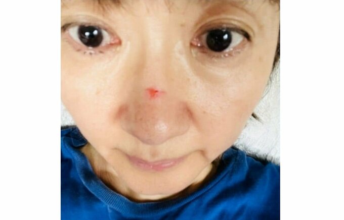 俳優・古村比呂さん　転倒し　顔を負傷　「イタァイ〜！！」「鼻をやってしまいました」「オデコ右打撲」|TBS NEWS DIG