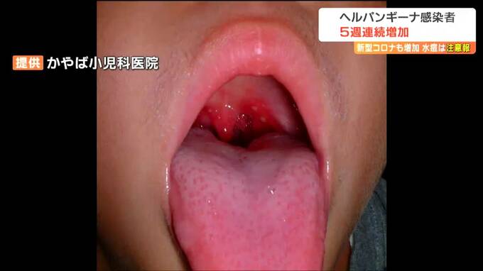 ヘルパンギーナ５週連続増加　みずぼうそうも全域に注意報　宮城　|　宮城のニュース│tbc NEWS│tbc東北放送