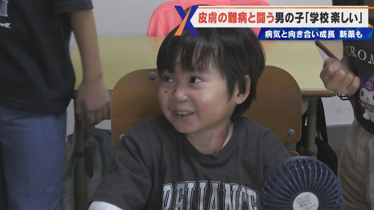 皮膚の難病｢表皮水疱症｣と闘う小学2年男児「少しの刺激で皮膚に