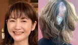 【 がん闘病 】古村比呂さん「頭皮の帯状疱疹になって 髪の毛が部分的にごっそりと抜けてから 約1年」「見事に生えてきました」|TBS NEWS DIG