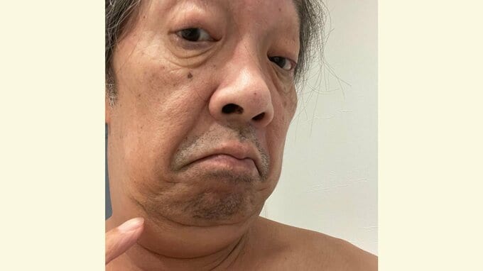 ステージ4【下咽頭がん】見栄晴さん "Yシャツが閉まらない" 放射線治療の影響で首の腫れ「まだ1～2ヶ月は腫れたまま」|TBS NEWS DIG