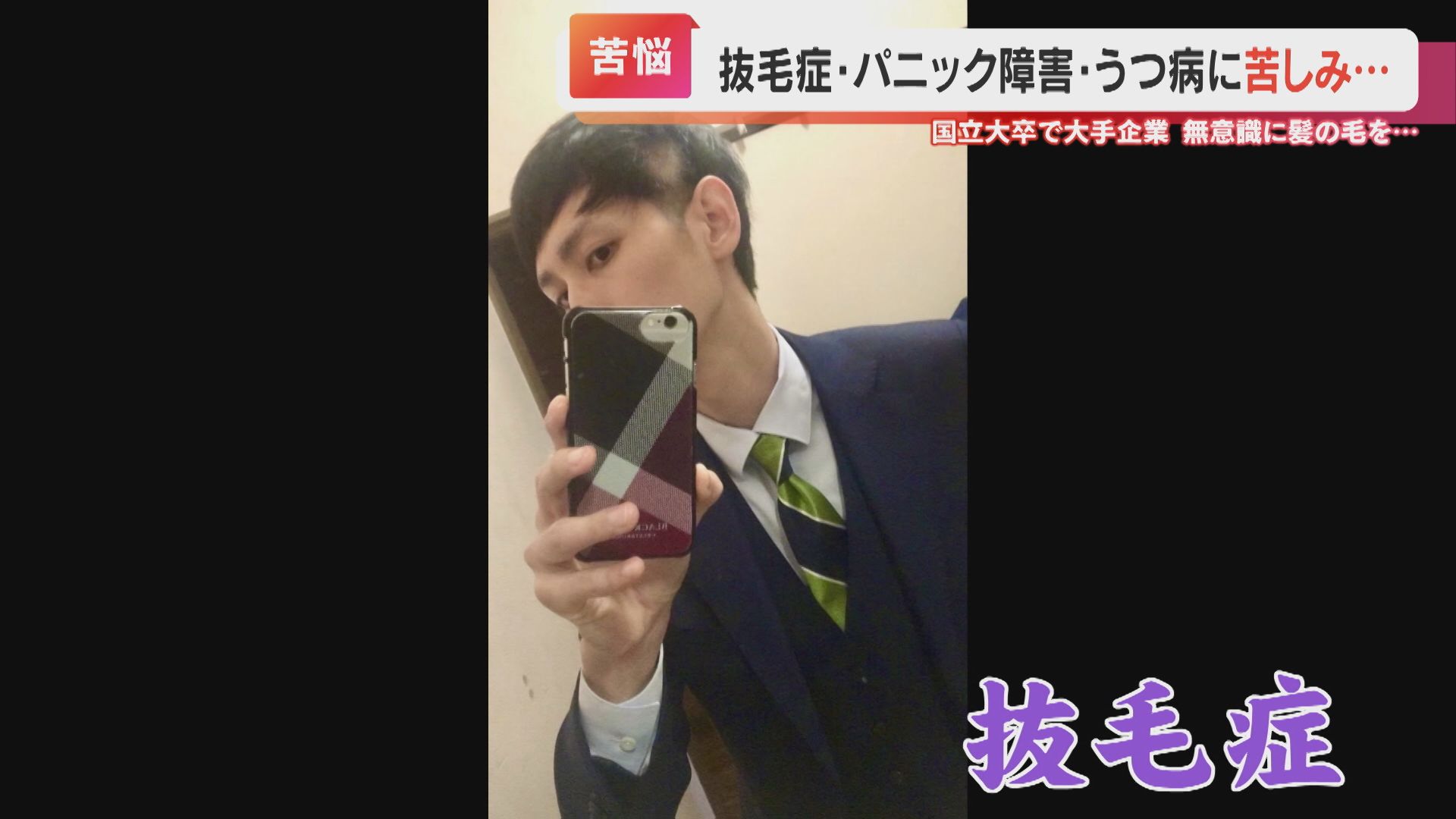 ストレス で 髪 を 抜く