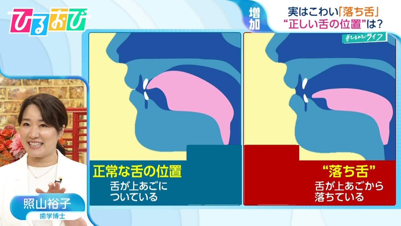実はこわい『落ち舌』 2人に1人傾向が…“正しい舌の位置”を保つ「グミ」を使ったトレーニングを歯科医が伝授【ひるおび】 | TBS NEWS DIG