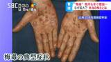 「梅毒」何年もかけて進行する恐ろしい病気…感染急拡大のワケ、ピンク色「発疹」手のひらの「カサカサした斑点」性行為など性器・口の粘膜接触で感染、本当の怖さを知らない世代が増加|TBS NEWS DIG