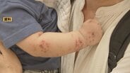 【手足口病】富山県内で猛威続く…6週連続で警報レベル「5人」突破、最新患者は8.36人　県が手洗いなど感染対策の徹底を呼びかけ　|　富山のニュース｜天気・防災｜チューリップテレビ