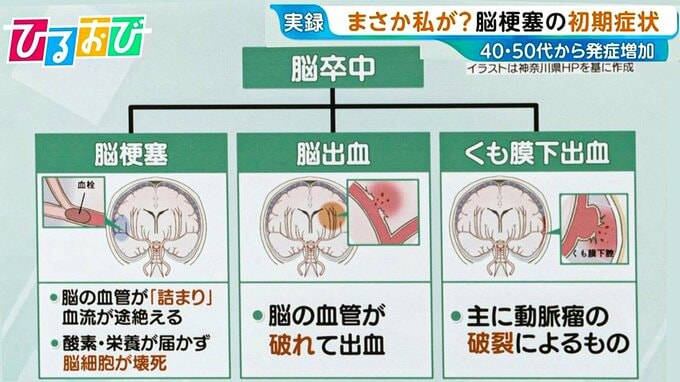 40代から増加「脳梗塞」の初期症状は？「倒れてからじゃ遅い」早期発見のカギ「BE FAST」とは【ひるおび】|TBS NEWS DIG