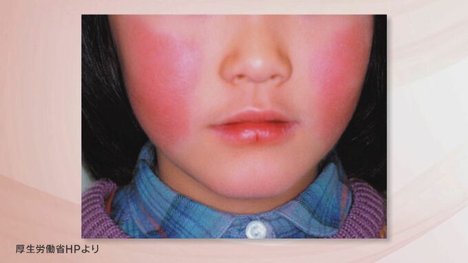 リンゴ病増加「警報レベル」続く　感染性胃腸炎も感染拡大　福島・5日発表　|　福島のニュース│TUF