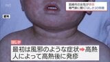 宮崎市で「はしか」患者を確認　「はしか」の特徴と危険性　|　MRTニュース ｜ ＭＲＴ宮崎放送