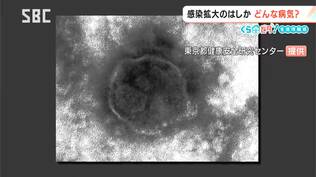 はしかの感染が拡大　【くらピタ！】　麻しんウイルスによる感染症　主に39度以上の発熱、咳・鼻水、全身の発しんなどの症状　「ワクチン空白世代」とは？　|　SBC NEWS | 長野のニュース | SBC信越放送