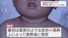 宮崎市で「はしか」患者を確認　「はしか」の特徴と危険性　|　MRTニュース ｜ ＭＲＴ宮崎放送