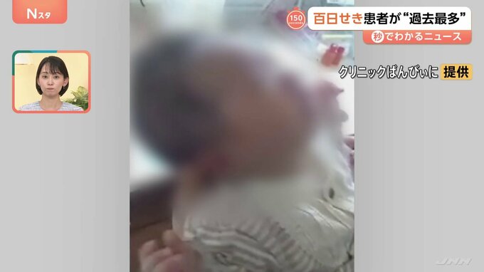 「本当に苦しくて涙が出るぐらい」百日せき患者が“過去最多”　乳幼児が感染すると重症化するおそれも【Nスタ解説】|TBS NEWS DIG
