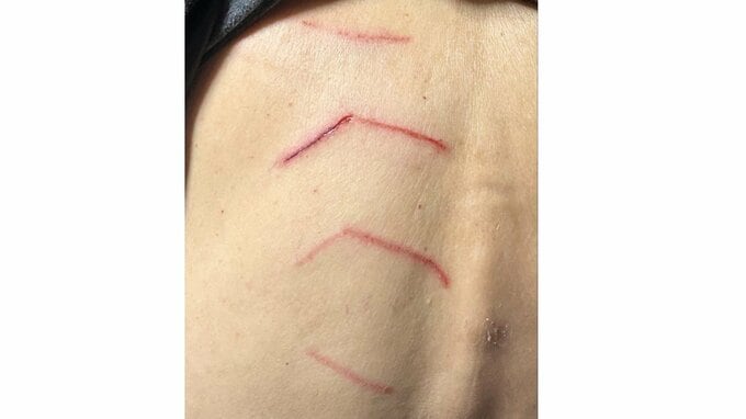 背中に傷が…「命を失わなくてよかった」クマに背後から襲われた女性　けさの出来事を記者に語る（山形・飯豊町）|TBS NEWS DIG