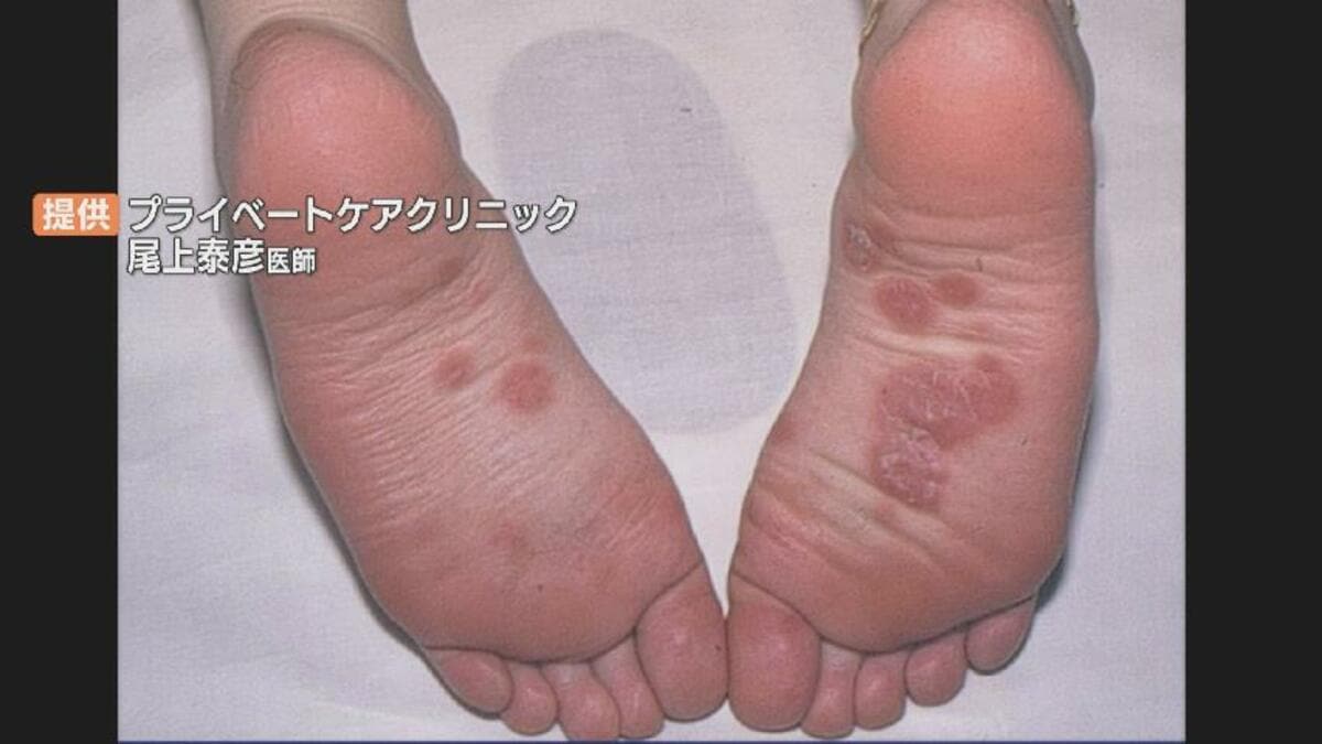 急増する梅毒、当事者の20代女性が語る“バラ疹”とまさかの再感染 最新治療の「筋肉注射」在庫切れのクリニックも | TBS NEWS DIG