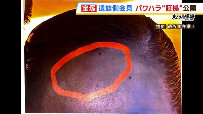 【宝塚】『やけど写真』やＬＩＮＥ文面「わざとな気する」遺族側がパワハラ証拠を公開|TBS NEWS DIG