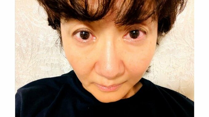 【がん闘病】古村比呂さん　浮腫みと目の赤みについて綴る　「どうも湿度はリンパ浮腫と眼の炎症と相性イマイチ」|TBS NEWS DIG