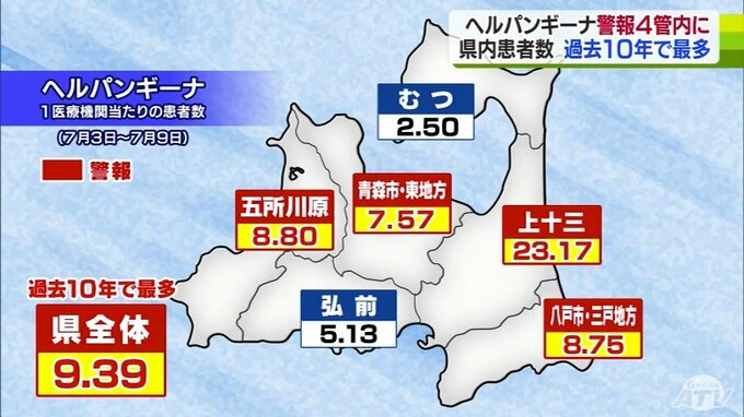 青森県ヘルパンギーナ患者　過去10年で最多に　警報レベル4保健所管内に拡大|TBS NEWS DIG