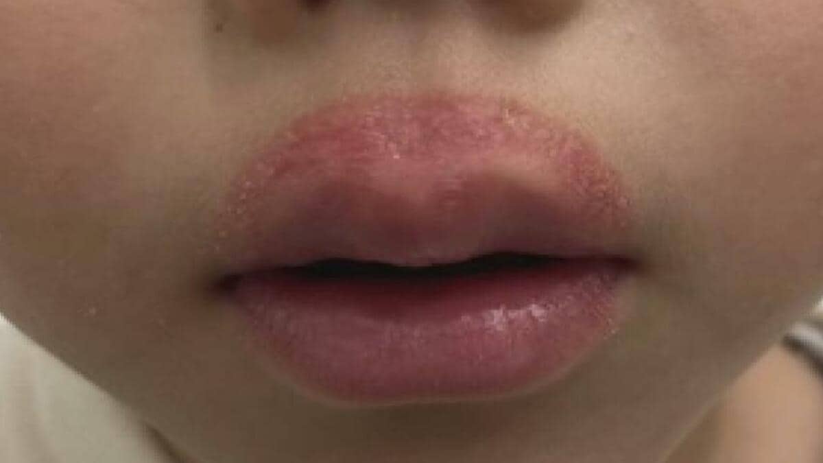 なめ まわし 皮膚 炎