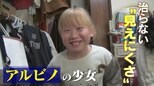 「宿題も鬼ごっこも大変です」2万人に1人の難病“アルビノ”の少女…色素が薄いだけでなく“弱視”との闘いが | 名古屋・愛知・岐阜・三重のニュース【CBC news】 | CBC web