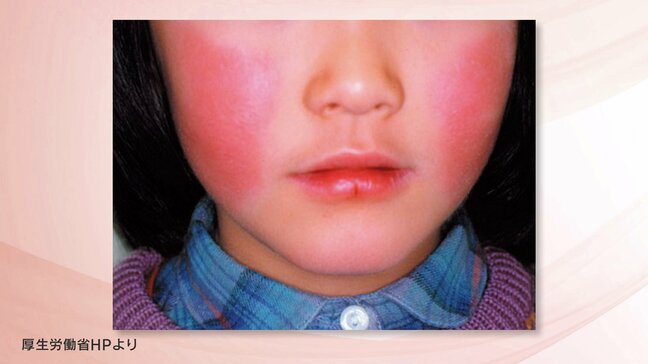 「リンゴ病」やや減少も流行続く…21週連続の警報レベル「百日ぜき」も注意　福島・5日発表|TBS NEWS DIG