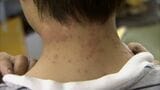 GW明けに大量発生することもある「チャドクガ」毒針毛に触れると発疹や強烈なかゆみ【岡山】|TBS NEWS DIG
