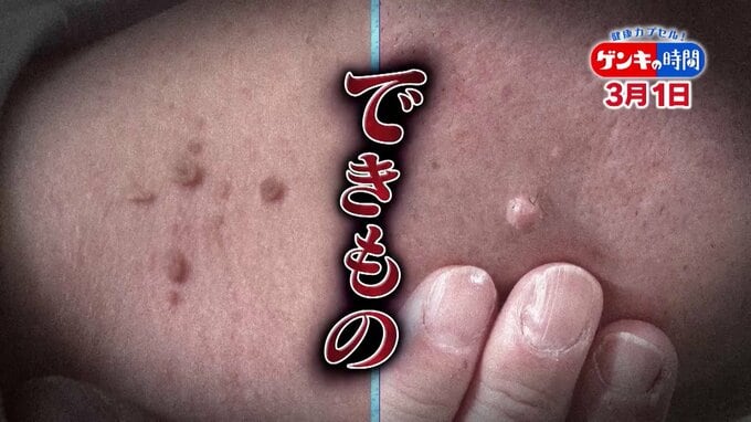 「悪性のできもの」見分けるポイント…「皮膚の変化」見逃すと危険！専門医に学ぶ！“悪性のできもの”のサイン　|　名古屋・愛知・岐阜・三重のニュース【CBC news】 | CBC web